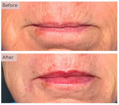 lip fillers before and afters
